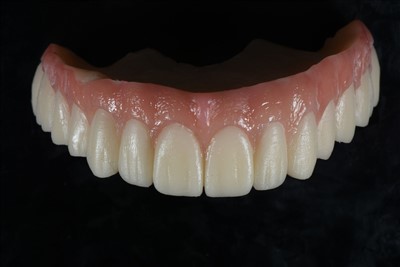 Acrylic Resin Tanporè Crown